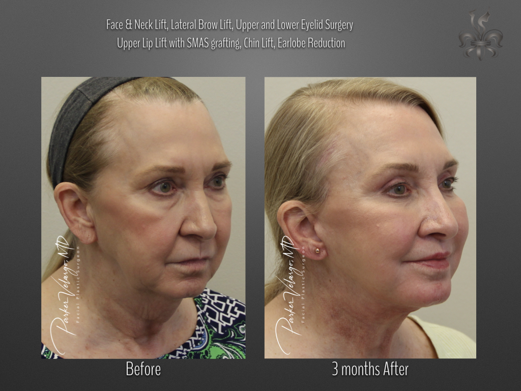 Brow Lift before and after