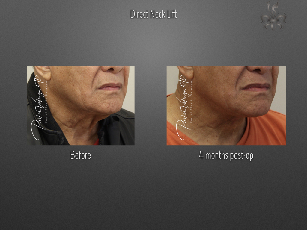 Direct Neck Lift before and after