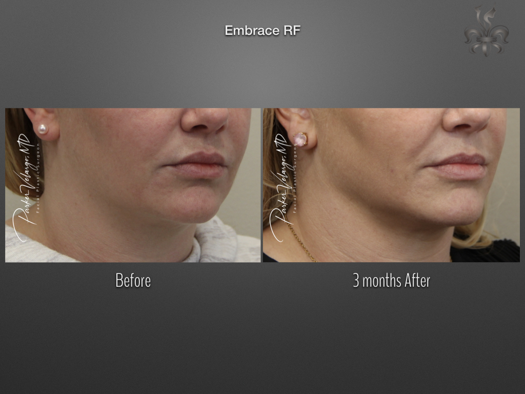 EmbraceRF before and after