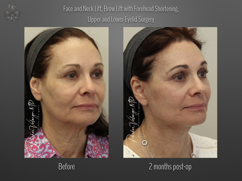 Face/Neck Lift before and after