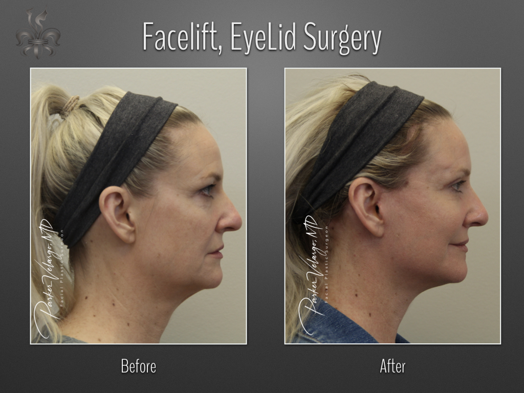 Face/Neck Lift before and after