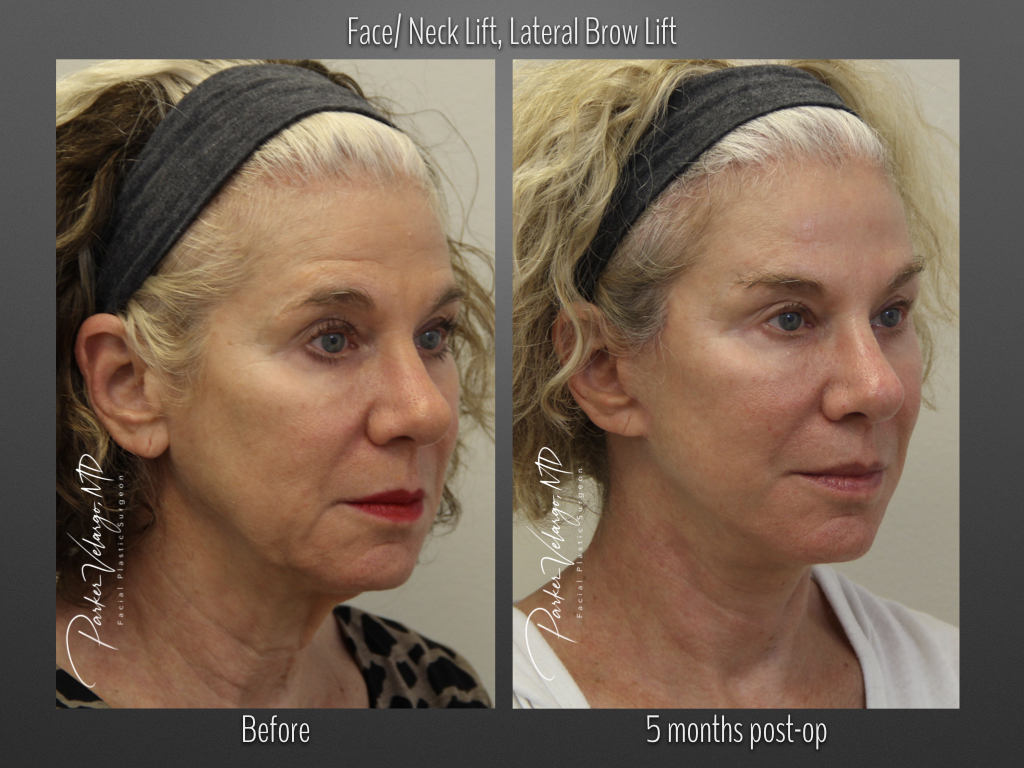 Face/Neck Lift before and after
