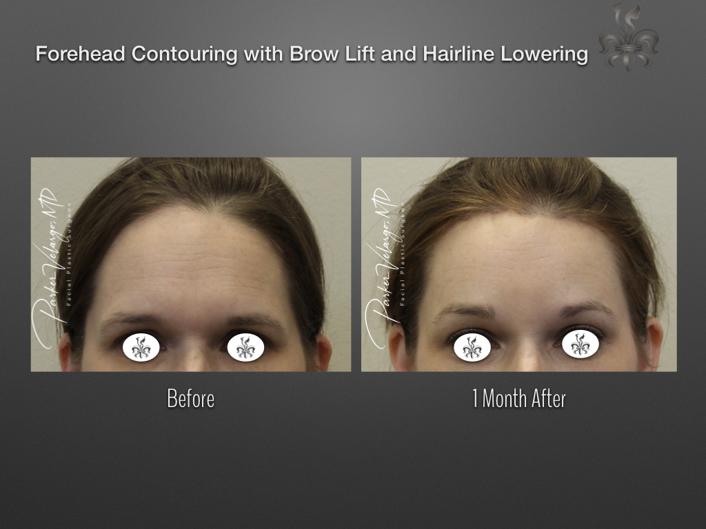 Facial Feminization before and after