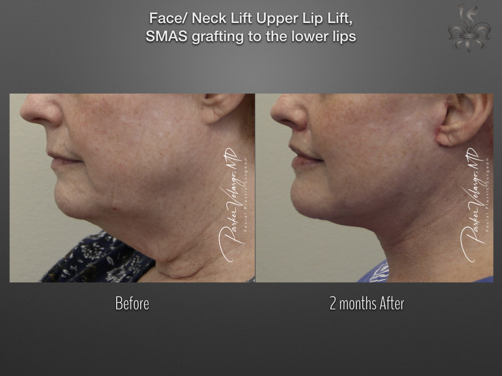 Lip Lift before and after
