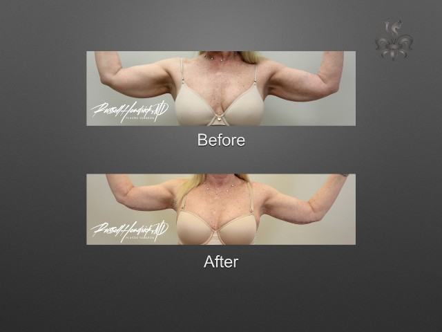 Brachioplasty (arm lift) before and after