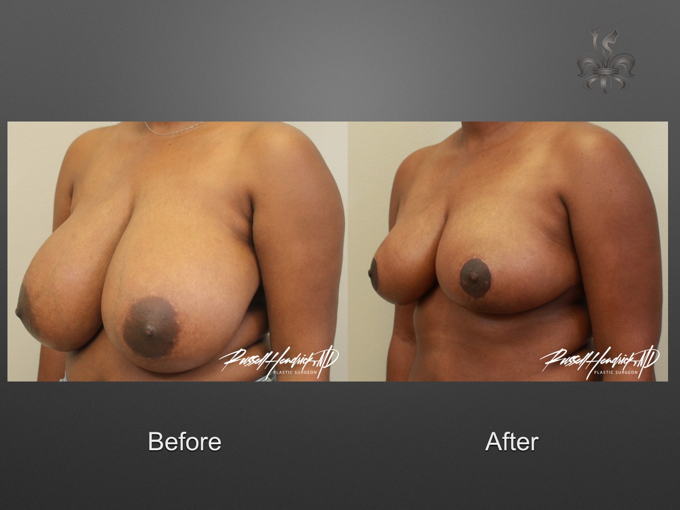 breast reduction before and after
