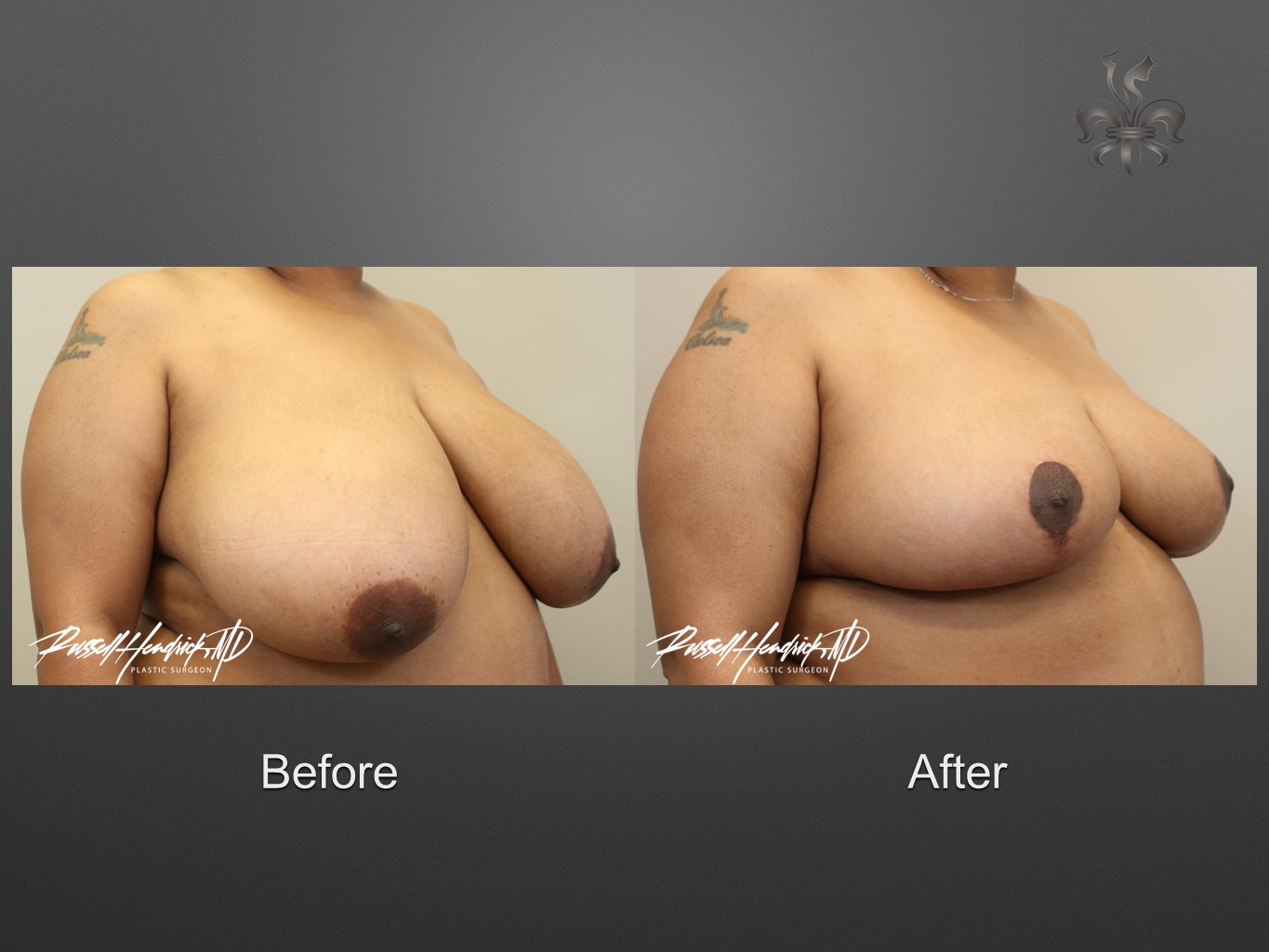 breast reduction before and after