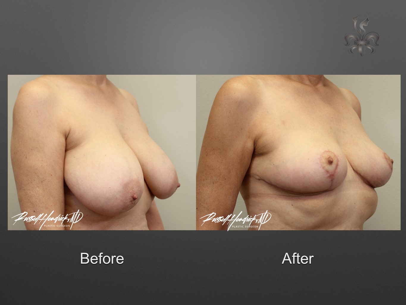 breast reduction before and after