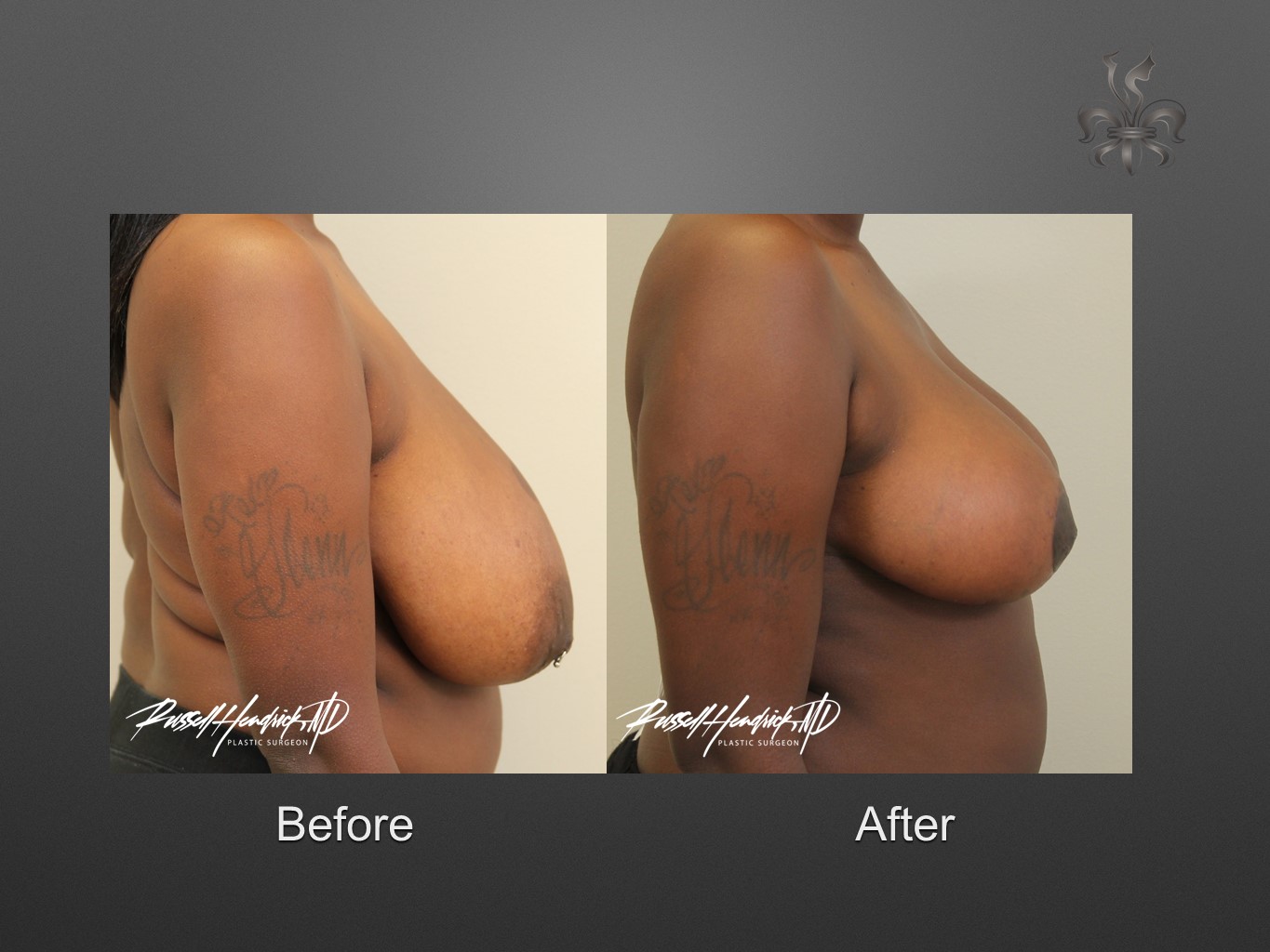 breast reduction before and after