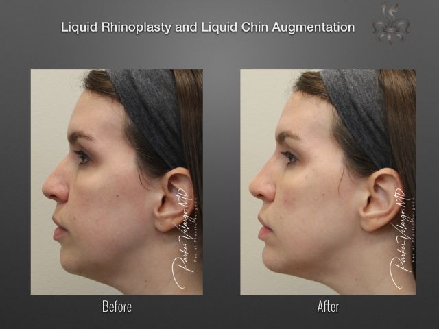 chin augmentation before and after