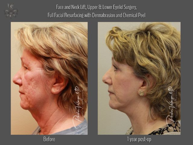 dermabrasion before and after