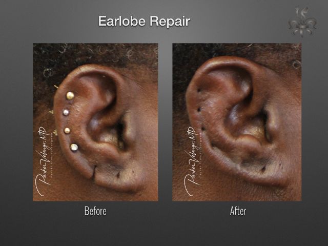 earlobe repair before and after