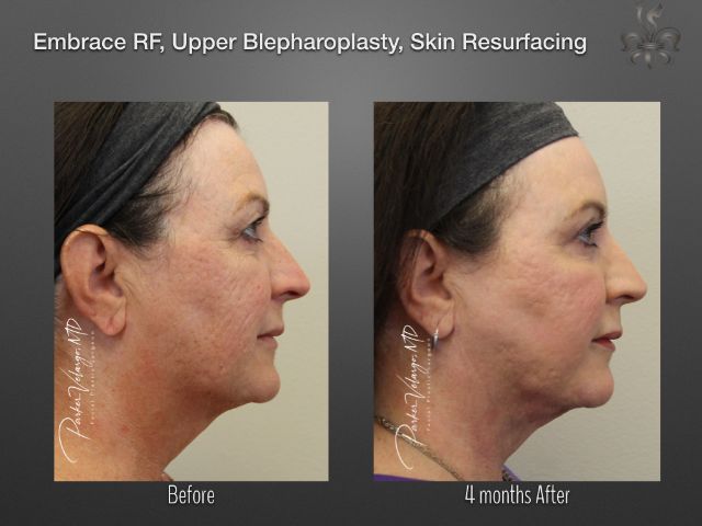 EmbraceRF before and after