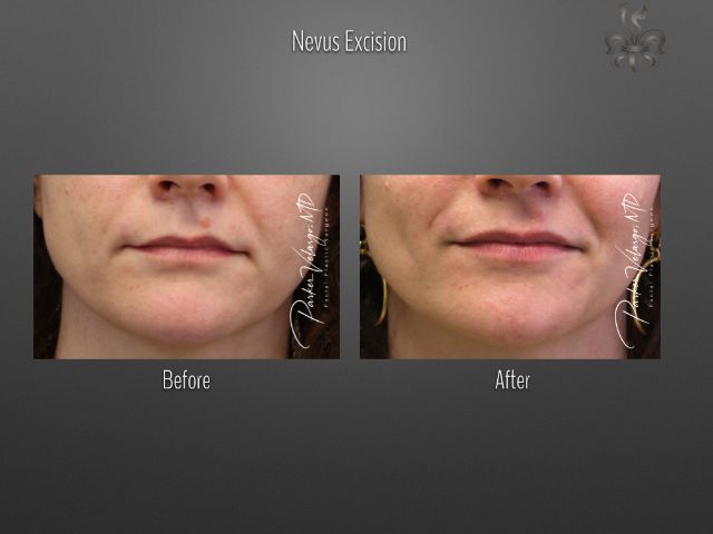 nevus excision before and after