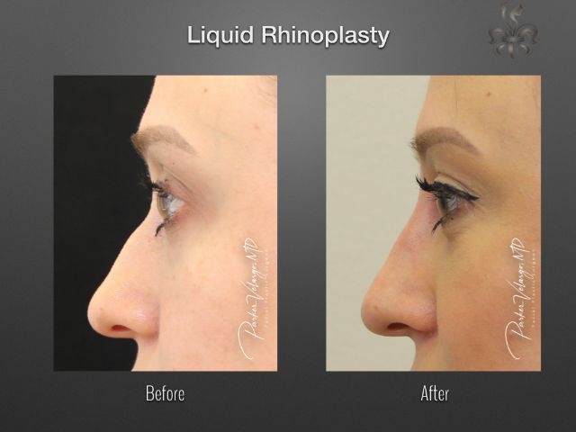 rhinoplasty before and after