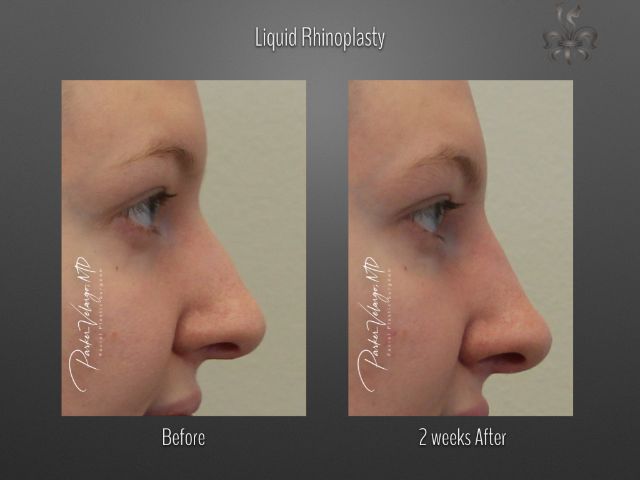 rhinoplasty before and after
