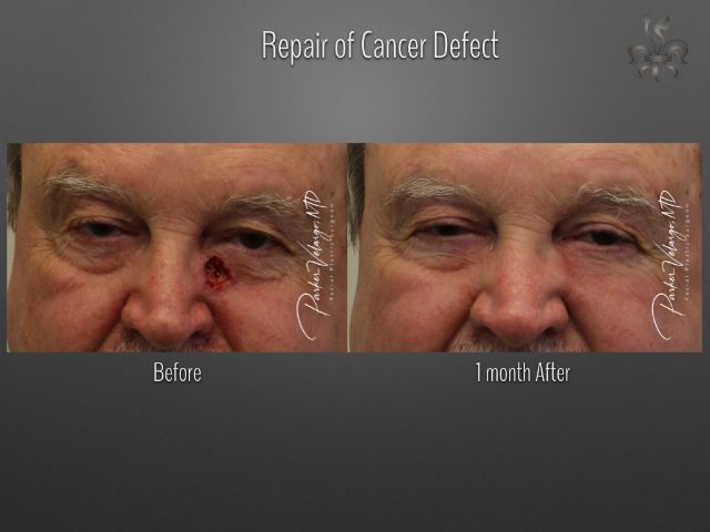 skin cancer reconstruction before and after