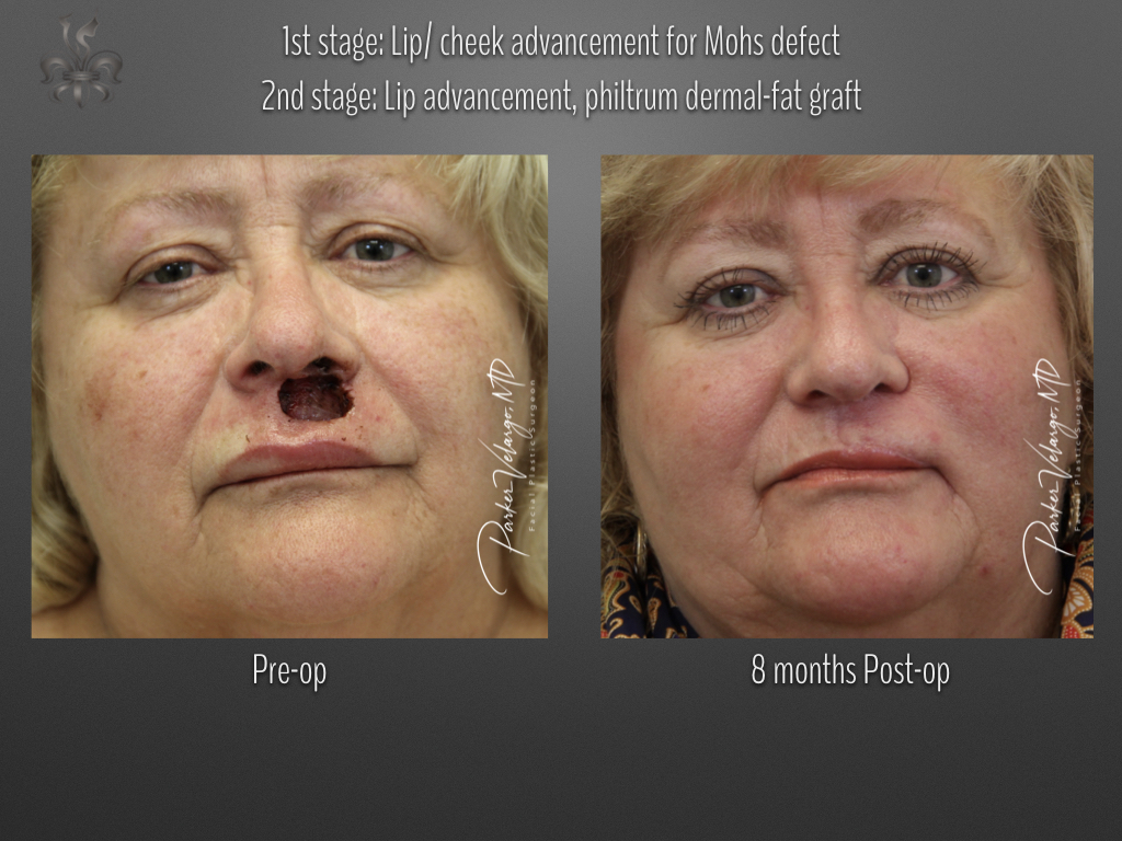 skin cancer reconstruction before & after
