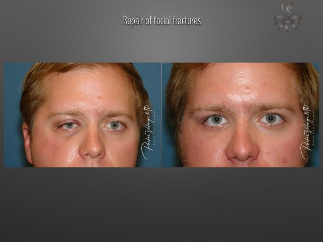 trauma repair before and after