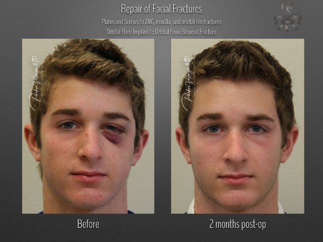 trauma repair before and after