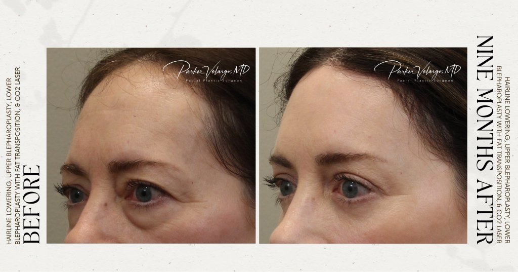 before and after deep brow lift left angle view female patient case 12316