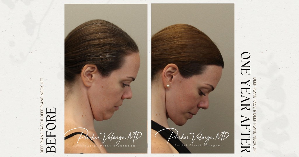 before and after deep brow lift right side down view female patient case 12320