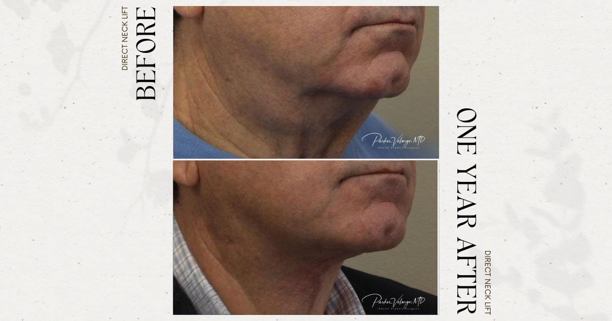 before and after neck lift male patient angle view case 12277