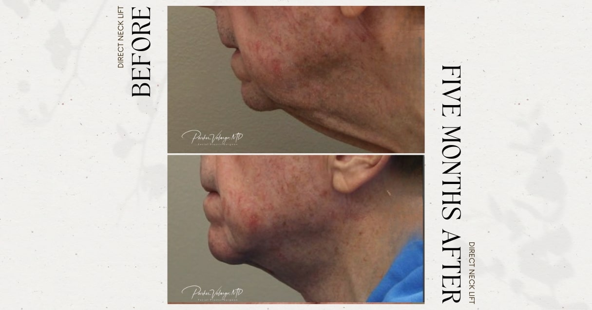 before and after neck lift male patient left side view case 12284