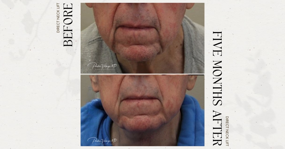 before and after neck lift male patient front view case 12284