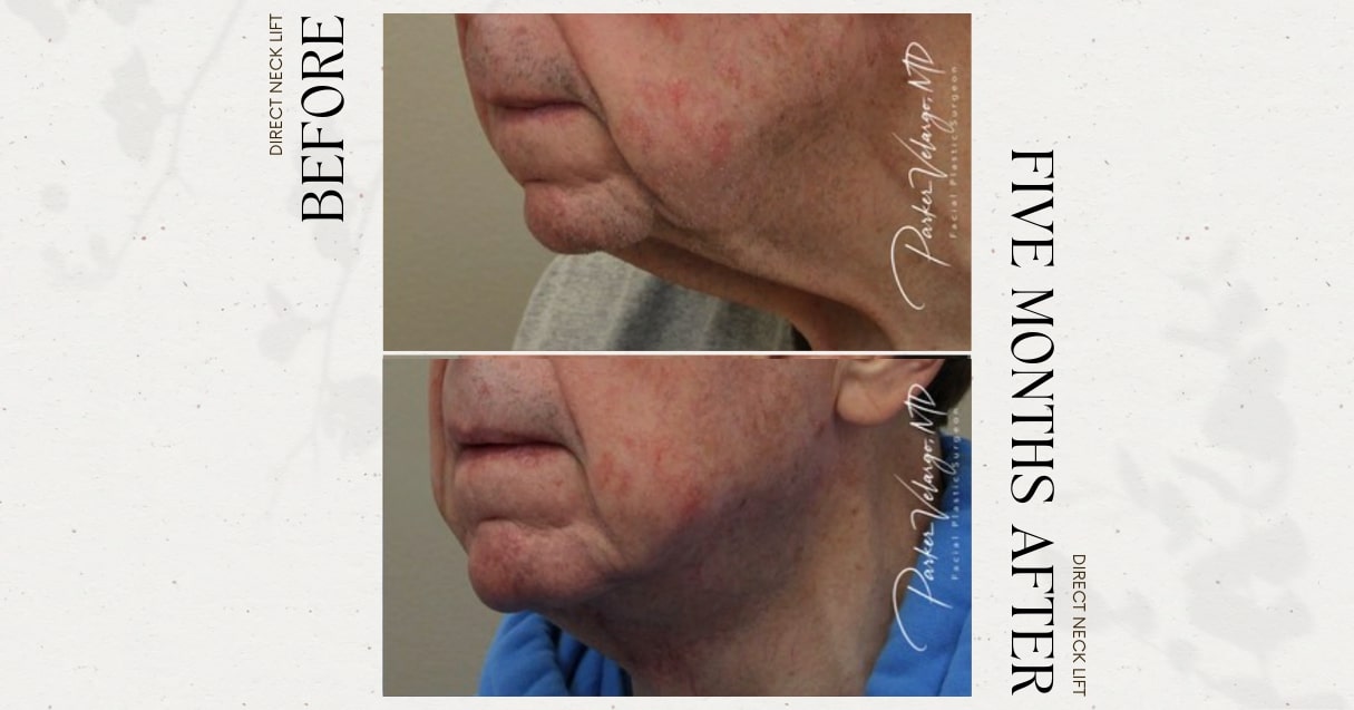 before and after neck lift male patient left angle view case 12284
