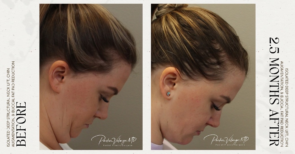 before and after deep structural neck lift right side down view female patient case 12353