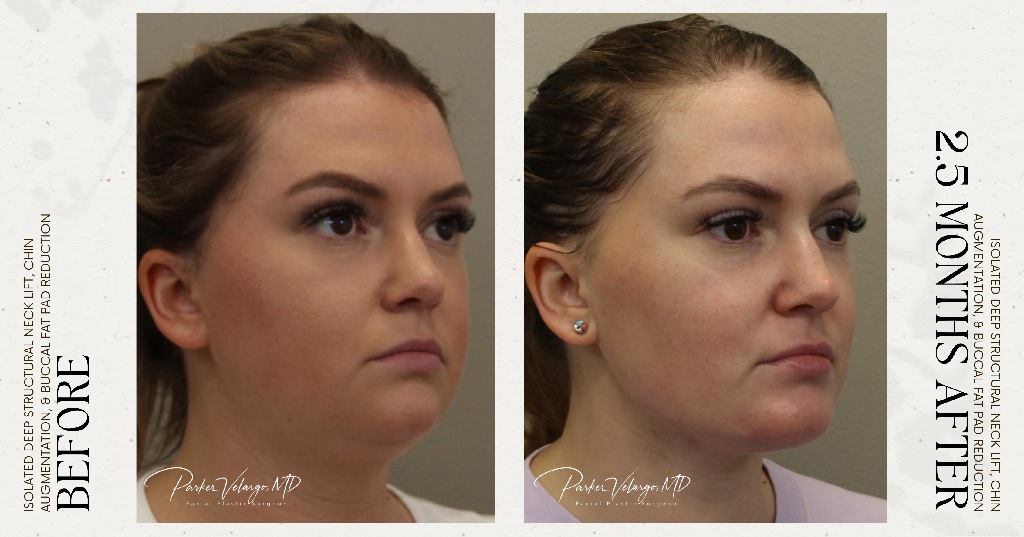 before and after deep structural neck lift right side angle view female patient case 12353