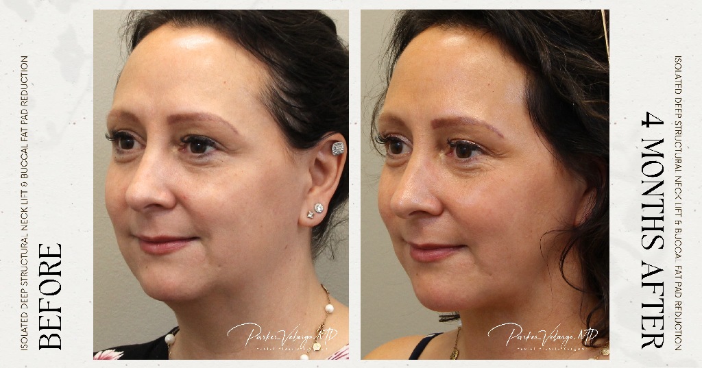 before and after deep structural neck lift left angle view female patient case 12358