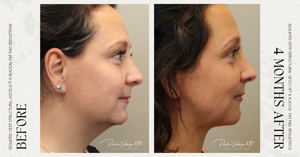 before and after deep structural neck lift right side view female patient case 12358