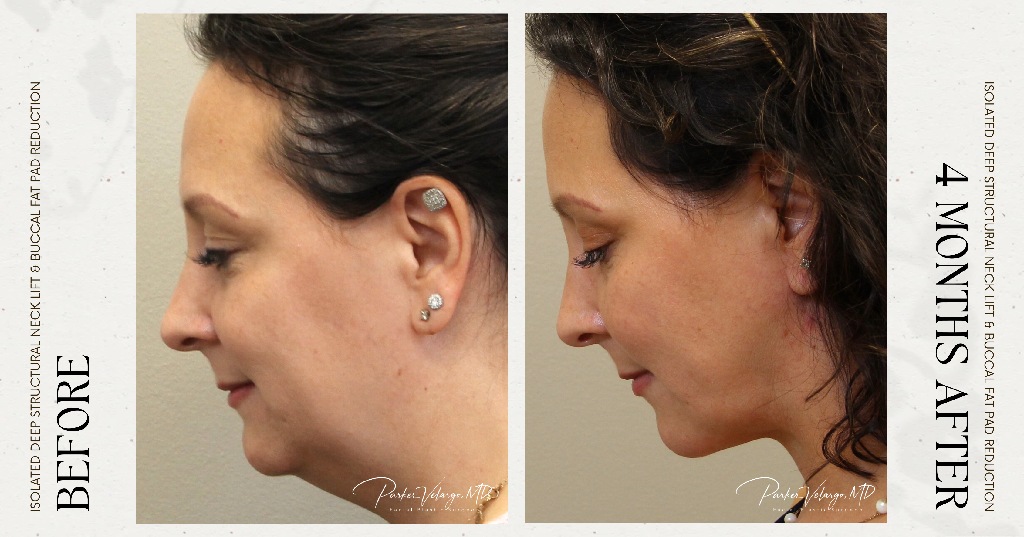 before and after deep structural neck lift left side view female patient case 12358