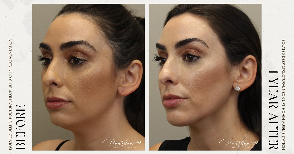 before and after deep structural neck lift left angle side view female patient case 12366