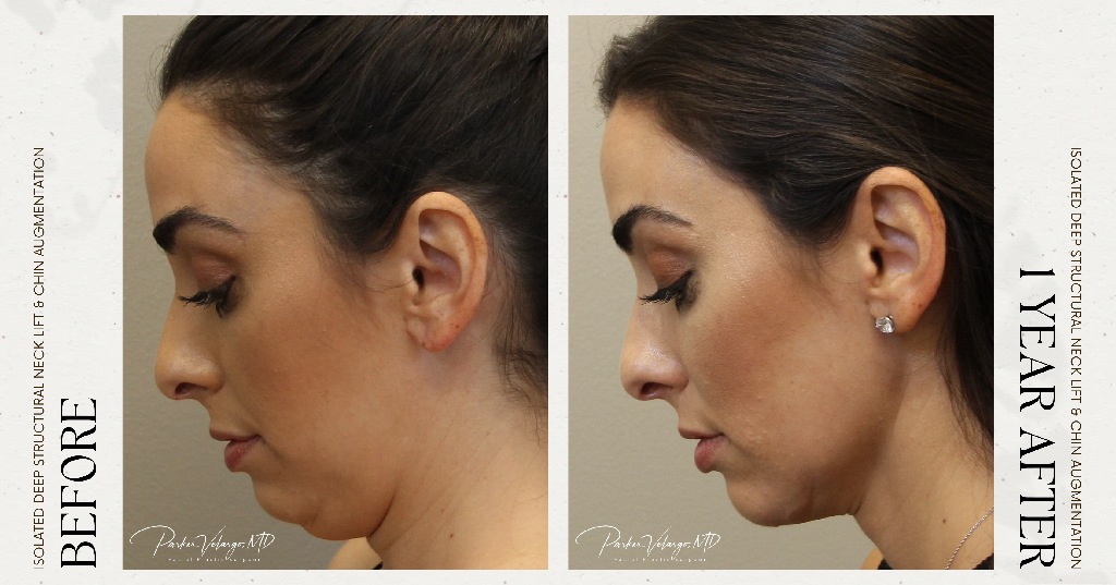 before and after deep structural neck lift left side view female patient case 12366
