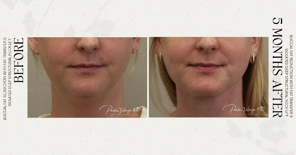 before and after deep structural neck lift right front view female patient case 12382