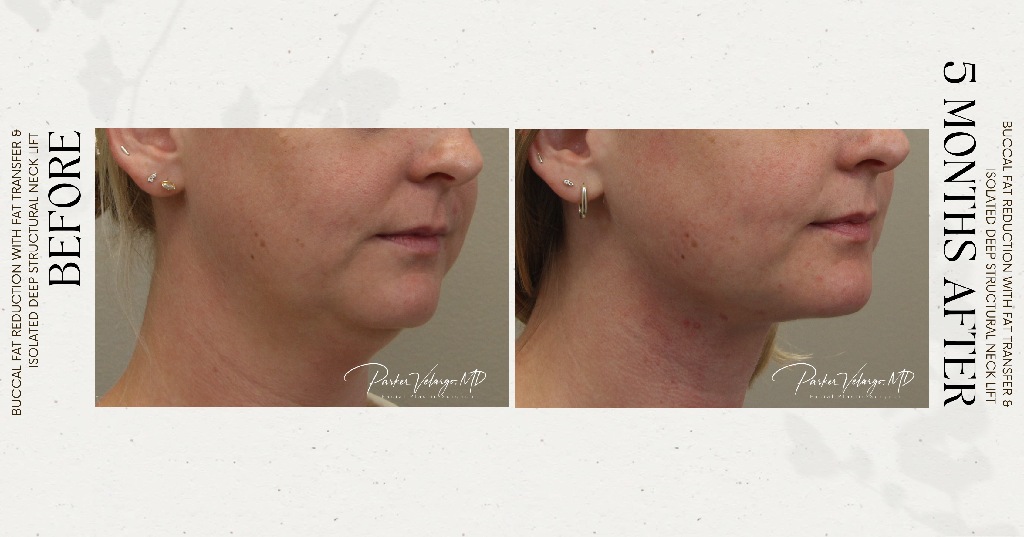before and after deep structural neck lift right right angle view female patient case 12382