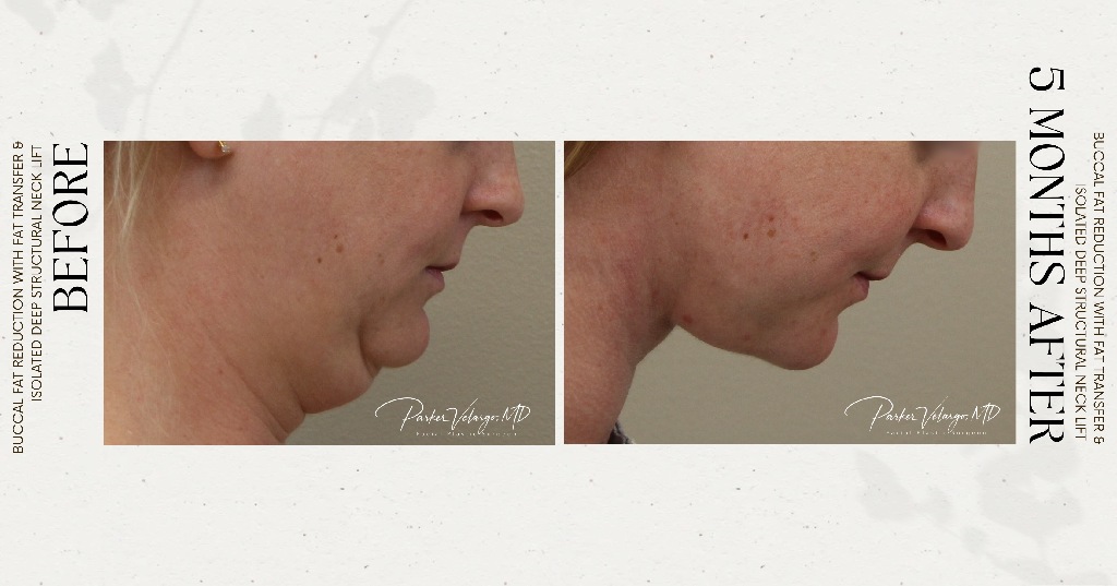before and after deep structural neck lift right side down view female patient case 12382