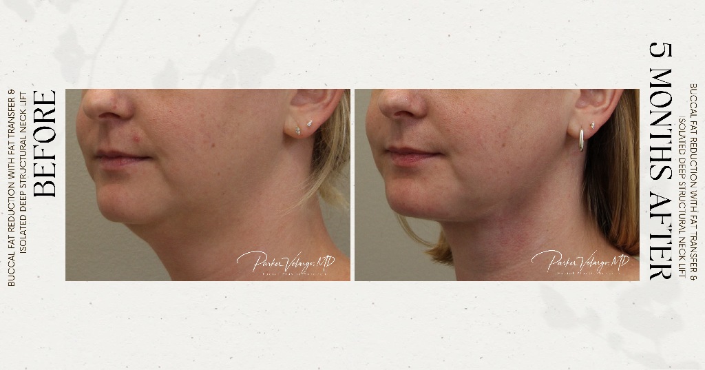before and after deep structural neck lift right left angle view female patient case 12382