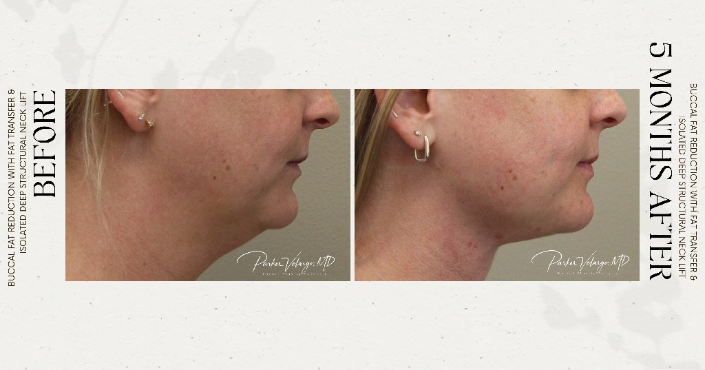 before and after deep structural neck lift right side view female patient case 12382
