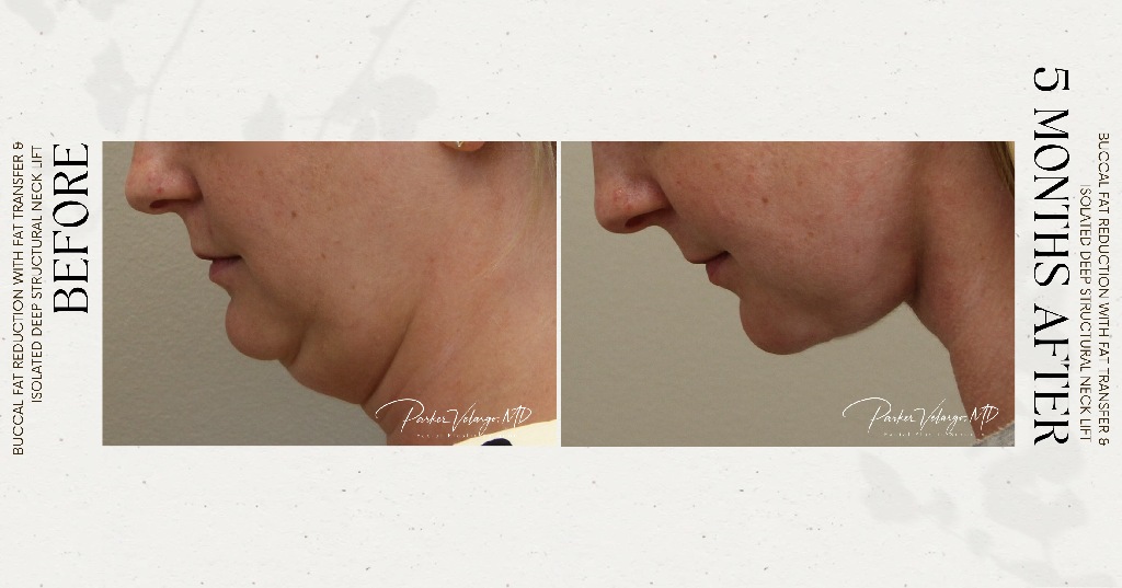 before and after deep structural neck lift right left side view female patient case 12382