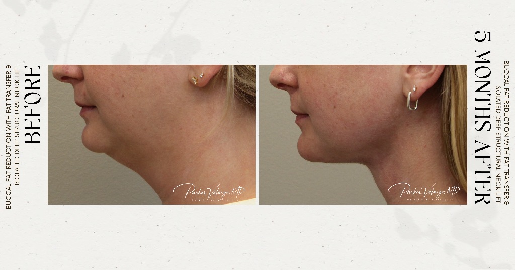 before and after deep structural neck lift new orleans right side view female patient case 12382
