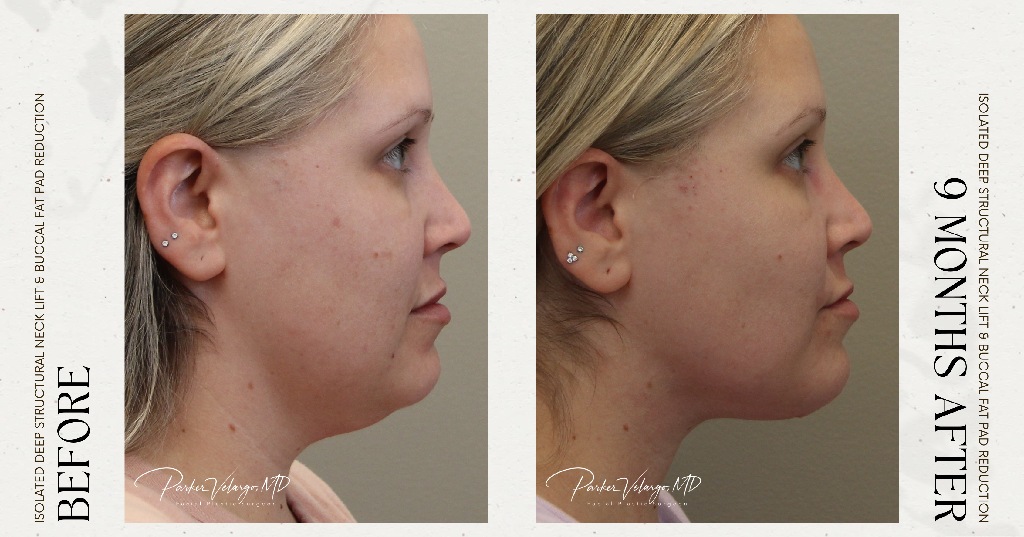 before and after deep structural neck lift side view female patient case 12390