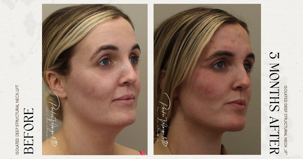 before and after deep structural neck lift angle view female patient case 12399