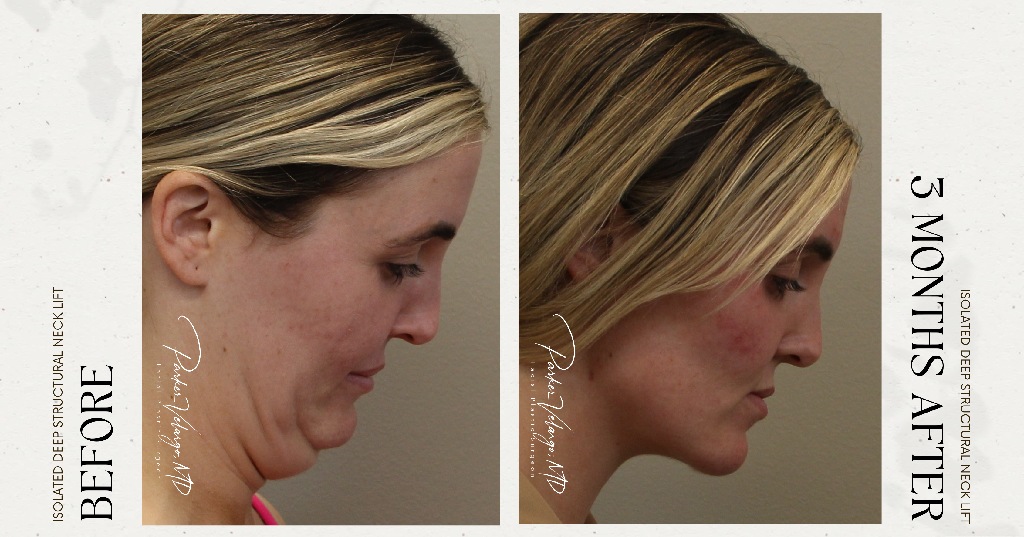 before and after deep structural neck lift side down view female patient case 12399