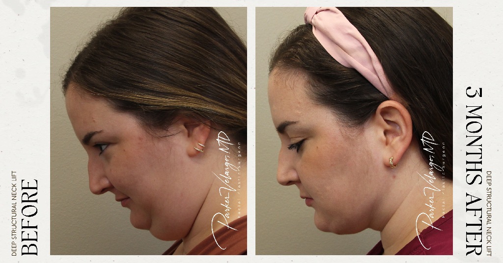 before and after deep structural neck lift new orleans side down view female patient case 12404