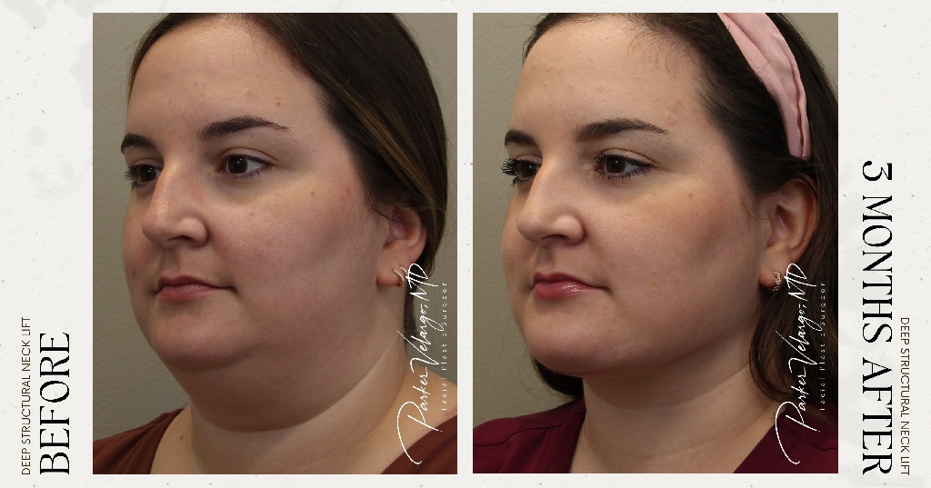 before and after deep structural neck lift new orleans angle view female patient case 12404
