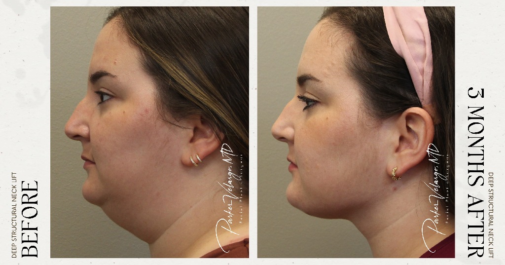 before and after deep structural neck lift new orleans side view female patient case 12404